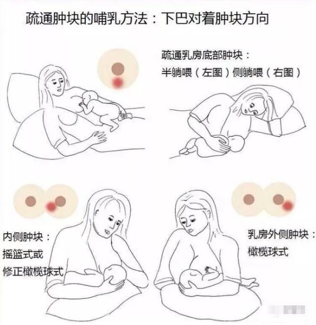 產(chǎn)后漲奶，疼痛難忍怎么辦？