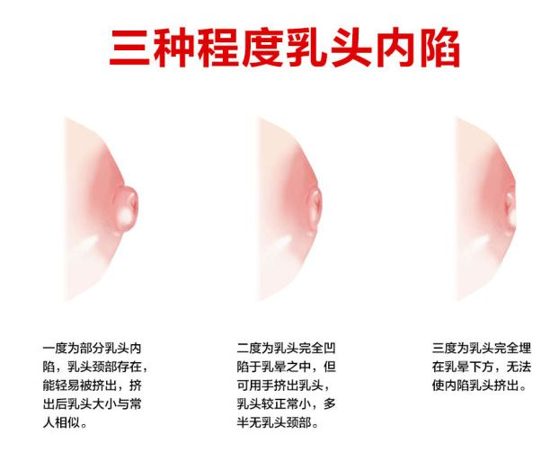 乳頭凹陷的媽媽該如何哺乳？