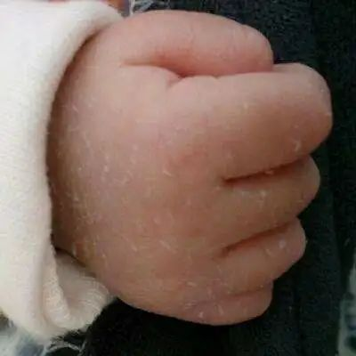 新生兒脫皮是正常的嗎？