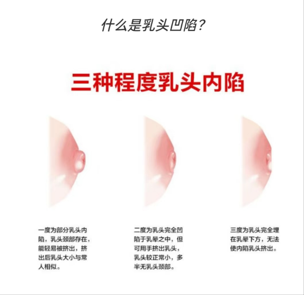 乳頭凹陷的媽媽該如何哺乳？