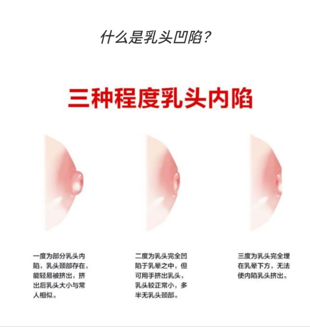 乳頭凹陷媽媽也能成功哺乳：應(yīng)對策略與孕期準(zhǔn)備
