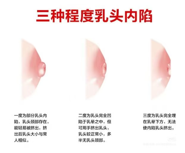 乳頭凹陷的媽媽該如何哺乳？